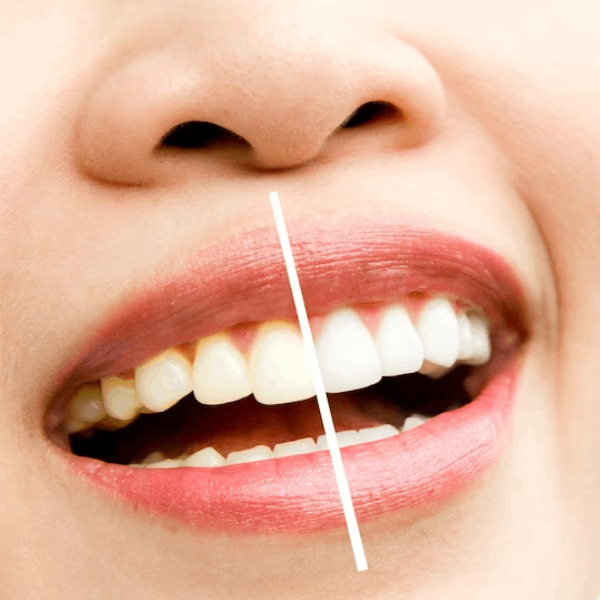 Bodrum Diş Hekimi - Diş Beyazlatma