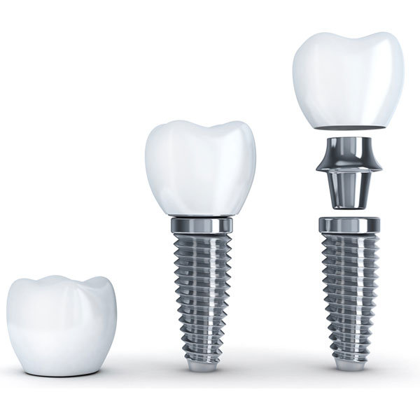 Bodrum Diş Hekimi - İmplant Tedavisi